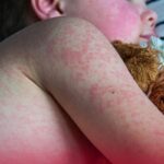 "Epidemia de sarampión en México: un retroceso alarmante, ¿responsabilidad del Estado y su jefe político?"