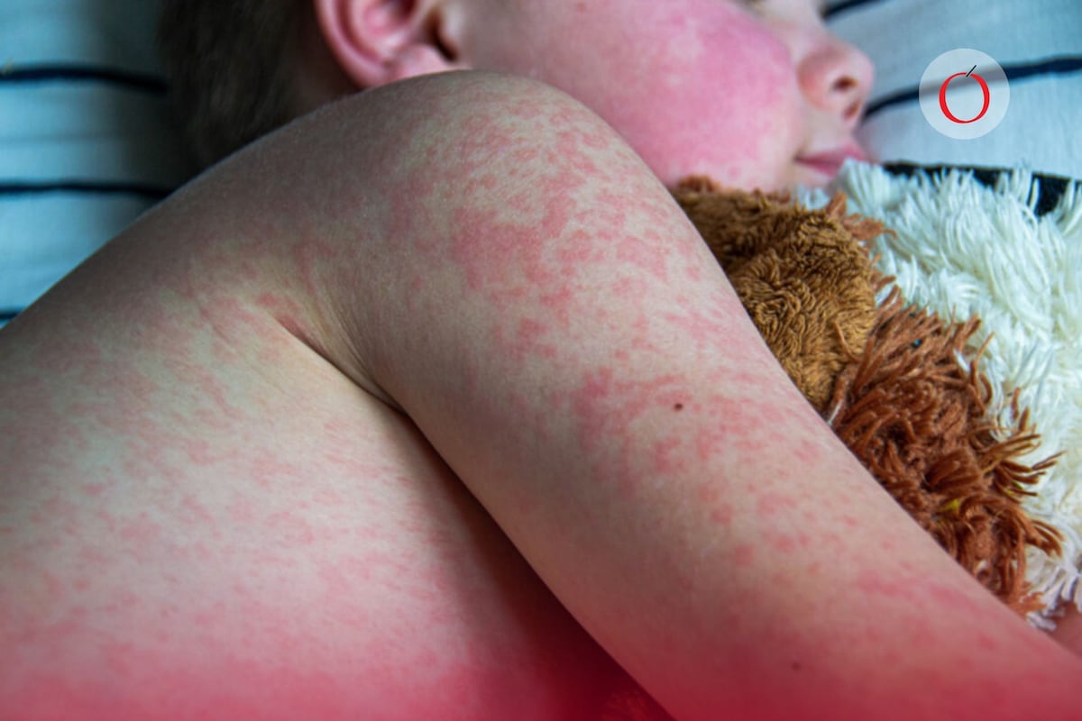 "Epidemia de sarampión en México: un retroceso alarmante, ¿responsabilidad del Estado y su jefe político?"